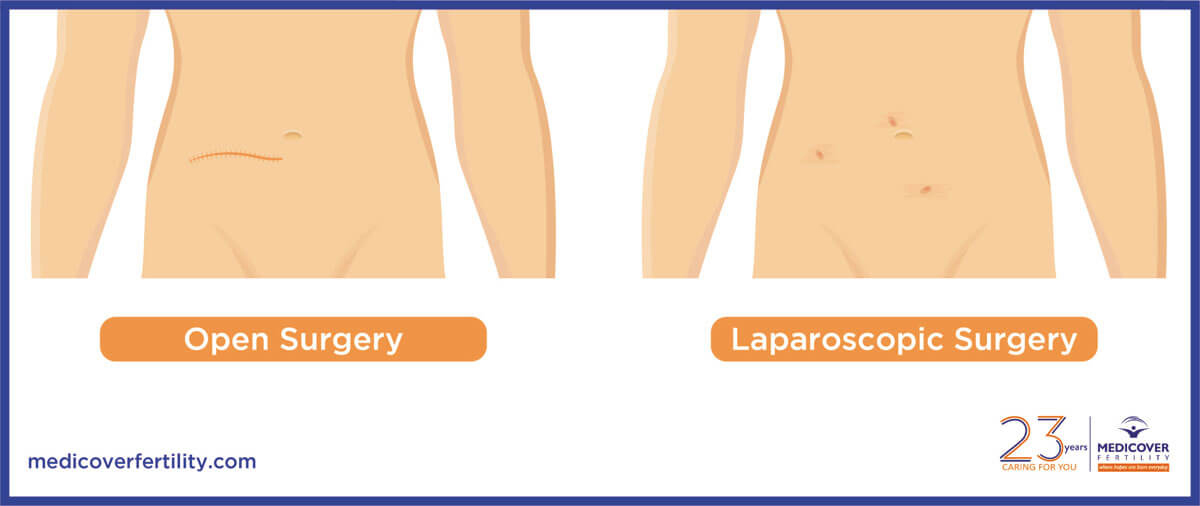 difference-between-laparoscopy-and-open-surgery_2