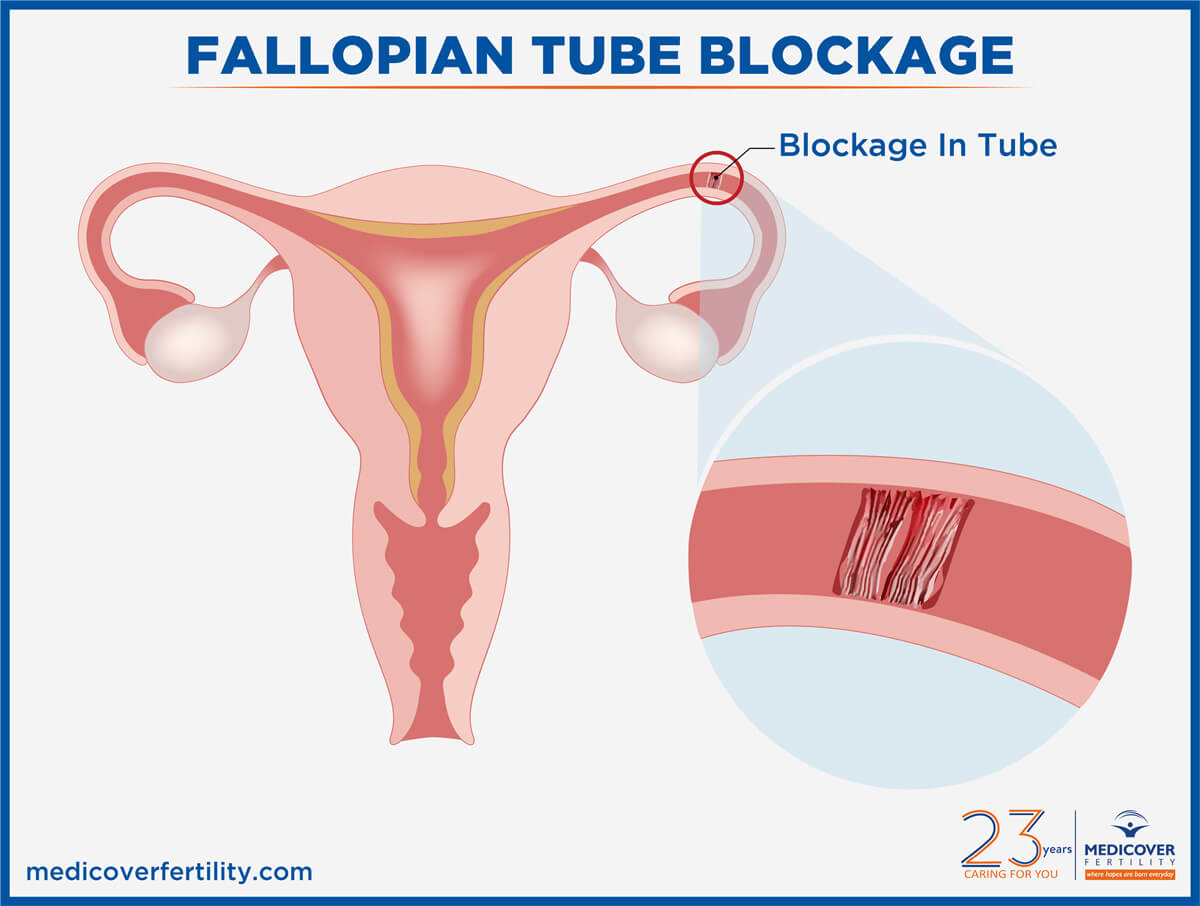 Fallopian Tube Blockage